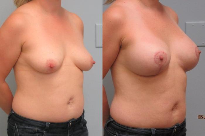 Before & After Breast Augmentation with Breast Lift  Case 22 Right Oblique View in Anchorage, AK