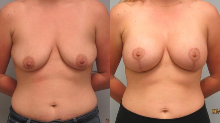 Before & After Breast Augmentation with Breast Lift  Case 53 Front View in Anchorage, AK