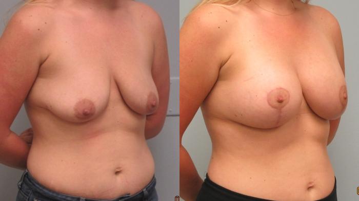 Before & After Breast Augmentation with Breast Lift  Case 53 Right Oblique View in Anchorage, AK