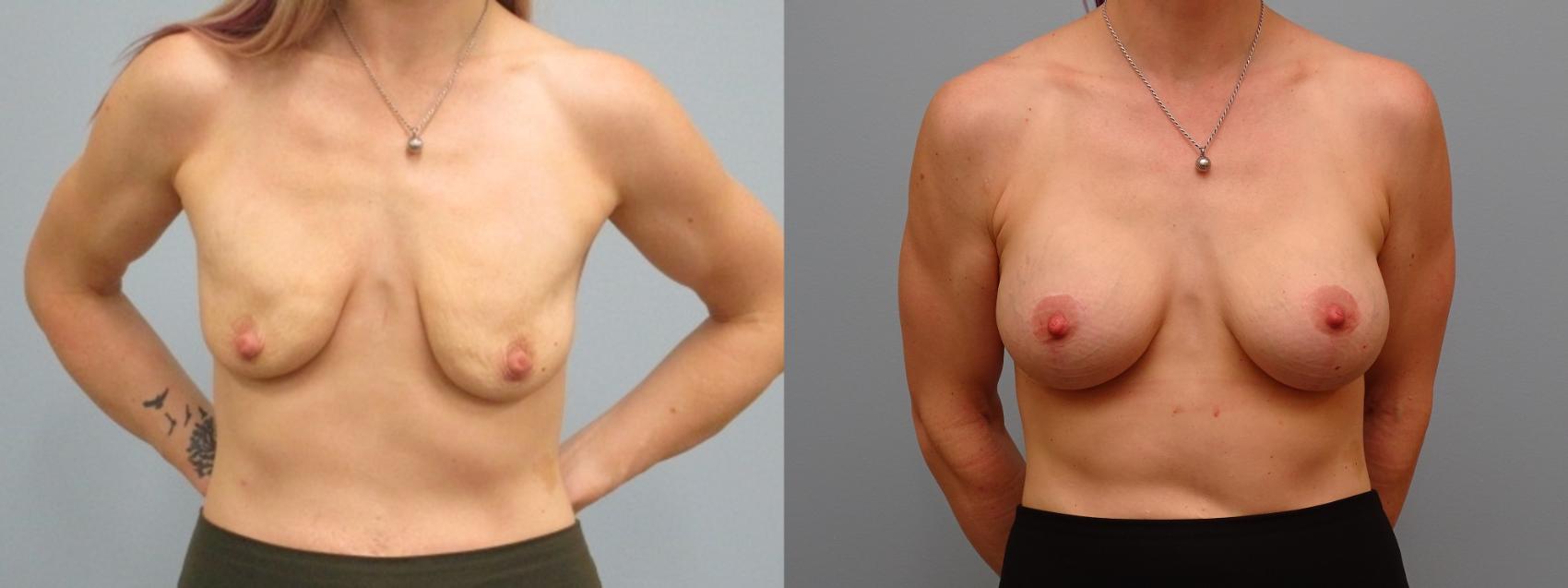 Before & After Breast Augmentation with Breast Lift  Case 65 Front View in Anchorage, AK