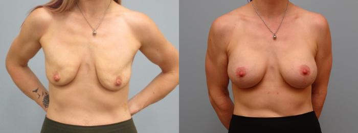 Before & After Breast Augmentation with Breast Lift  Case 65 Front View in Anchorage, AK