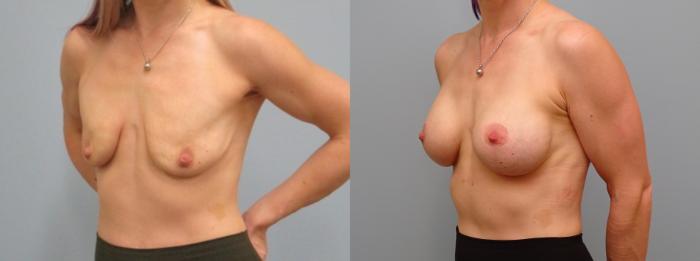 Before & After Breast Augmentation with Breast Lift  Case 65 Left Oblique View in Anchorage, AK