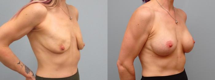 Before & After Breast Augmentation with Breast Lift  Case 65 Right Oblique View in Anchorage, AK