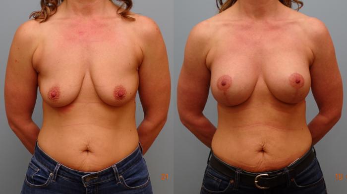 Before & After Breast Augmentation with Breast Lift  Case 87 Front View in Anchorage, AK