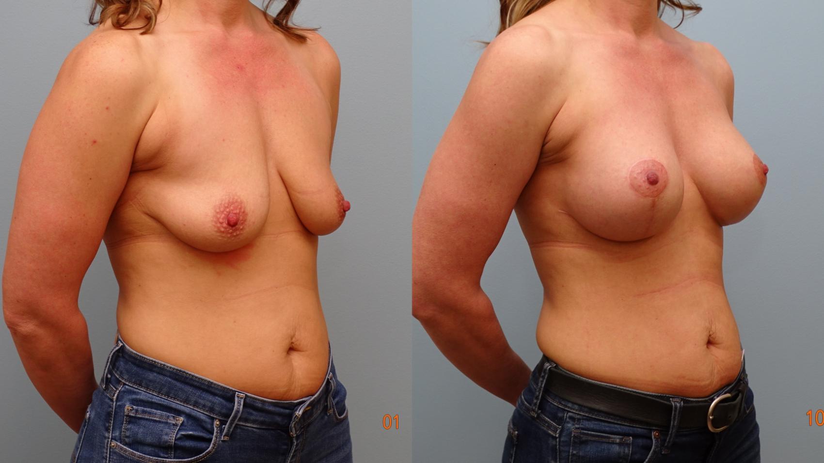 Before & After Breast Augmentation with Breast Lift  Case 87 Right Oblique View in Anchorage, AK