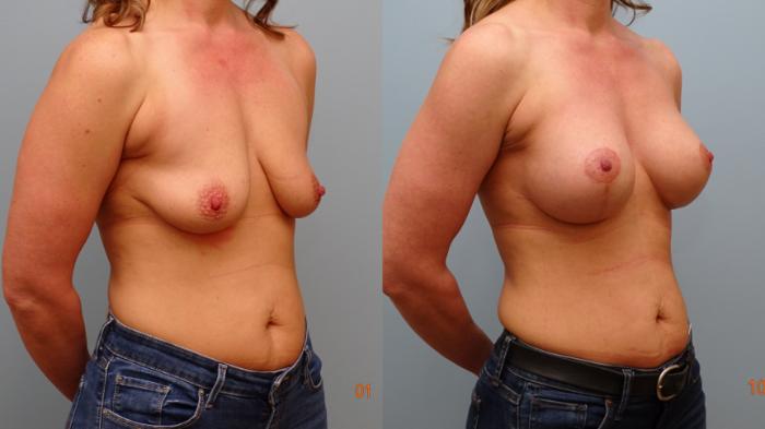 Before & After Breast Augmentation with Breast Lift  Case 87 Right Oblique View in Anchorage, AK