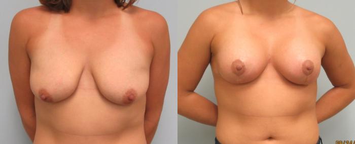 Before & After Breast Augmentation with Breast Lift  Case 88 Front View in Anchorage, AK
