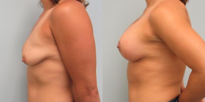 Before & After Breast Augmentation with Breast Lift  Case 88 Left Side View in Anchorage, AK