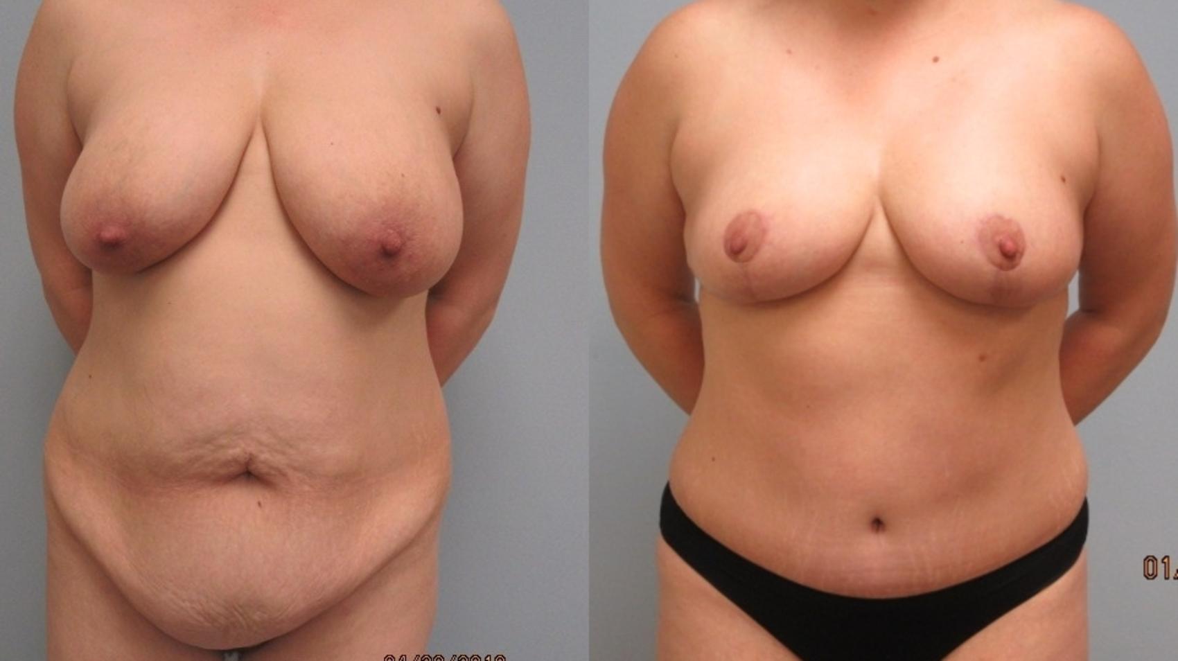 Before & After Breast Lift Case 15 Front View in Anchorage, AK