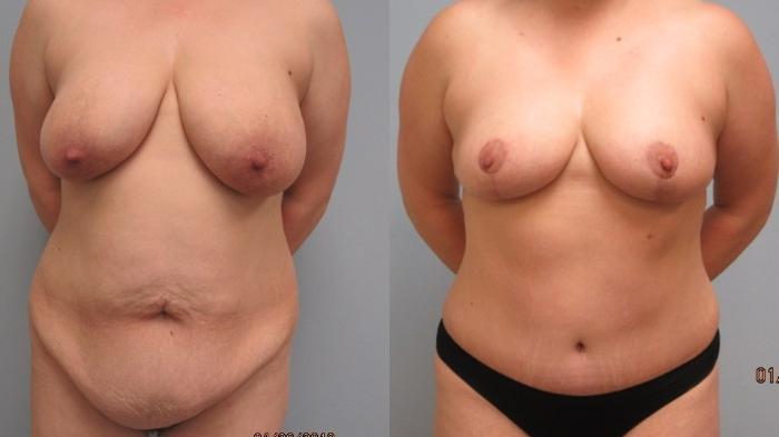 Before & After Tummy Tuck Case 15 Front View in Anchorage, AK