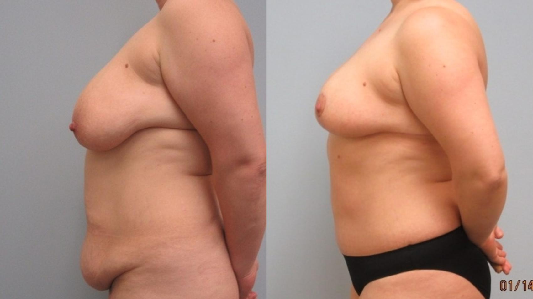 Before & After Breast Lift Case 15 Left Side View in Anchorage, AK