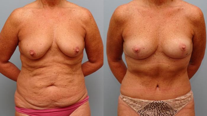 Before & After Breast Lift Case 40 Front View in Anchorage, AK