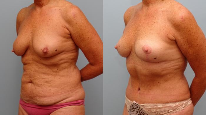 Before & After Breast Lift Case 40 Left Oblique View in Anchorage, AK