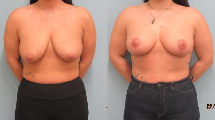 Before & After Breast Lift Case 47 Front View in Anchorage, AK