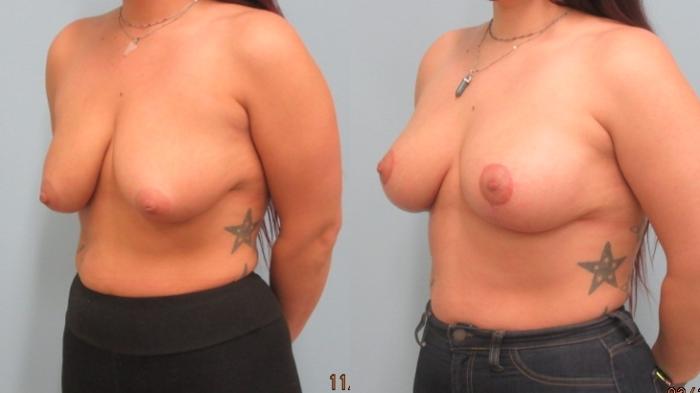 Before & After Breast Lift Case 47 Left Oblique View in Anchorage, AK