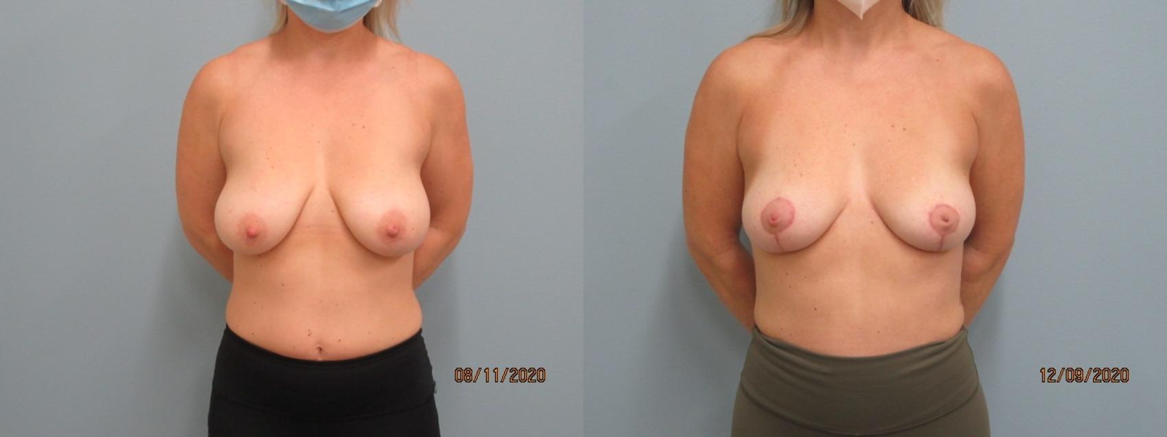 Before & After Breast Lift Case 49 Front View in Anchorage, AK