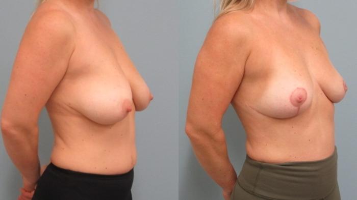 Before & After Breast Lift Case 49 Right Oblique View in Anchorage, AK