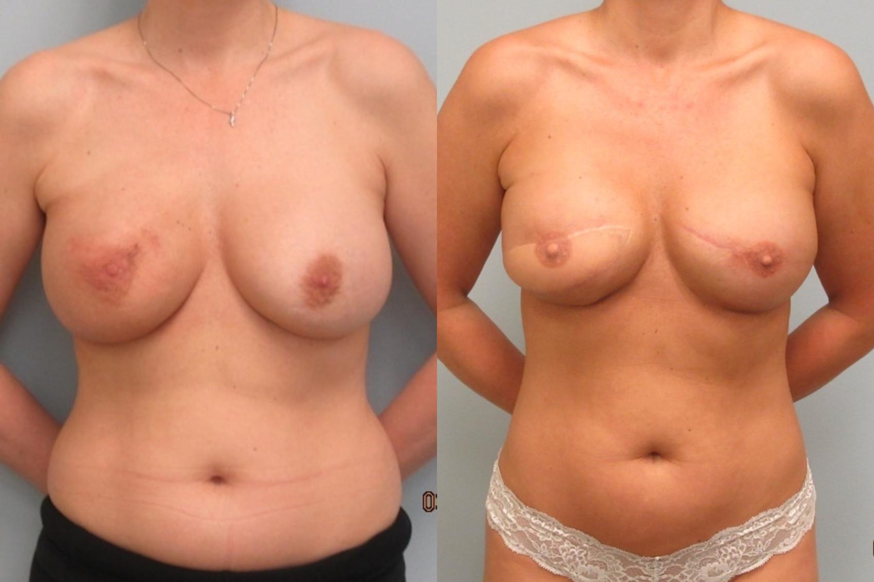 Before & After Breast Reconstruction Case 27 Front View in Anchorage, AK