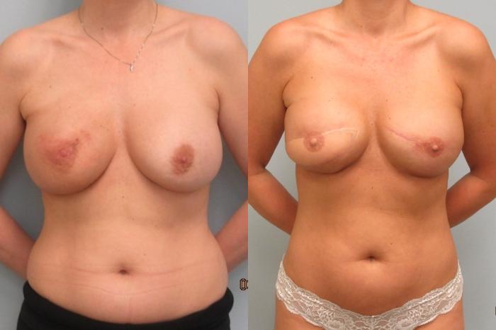 Before & After Breast Reconstruction Case 27 Front View in Anchorage, AK