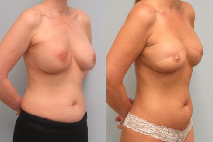 Before & After Breast Reconstruction Case 27 Right Oblique View in Anchorage, AK