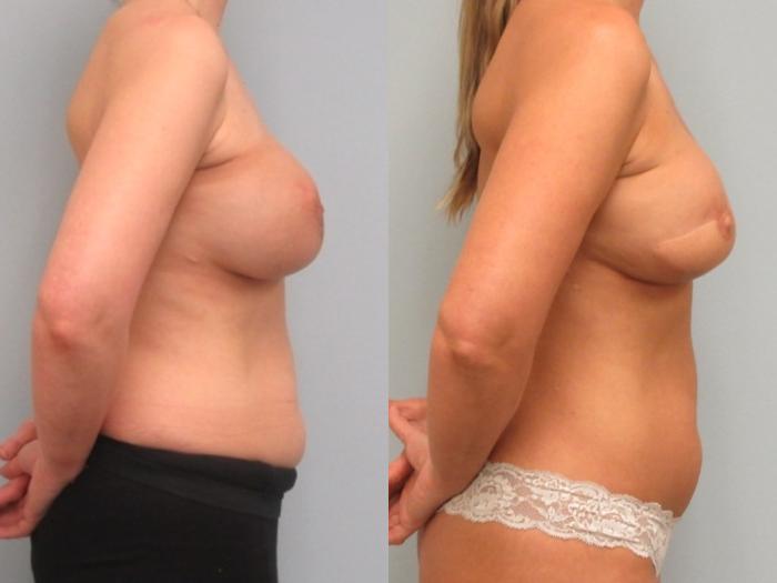Before & After Breast Reconstruction Case 27 Right Side View in Anchorage, AK