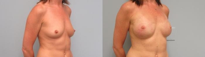 Before & After Breast Reconstruction Case 3 Right Oblique View in Anchorage, AK