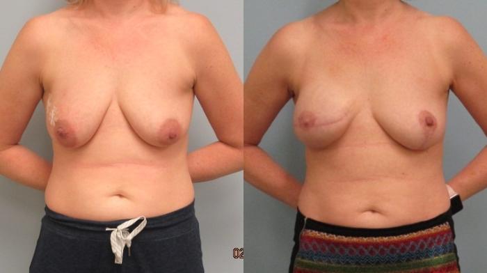 Before & After Breast Reconstruction Case 48 Front View in Anchorage, AK
