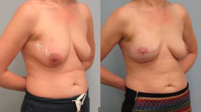 Before & After Breast Reconstruction Case 48 Right Oblique View in Anchorage, AK