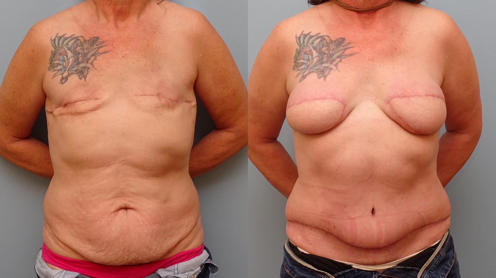 Before & After Breast Reconstruction Case 58 Front View in Anchorage, AK