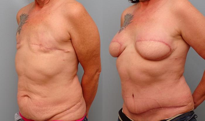 Before & After Breast Reconstruction Case 58 Left Oblique View in Anchorage, AK