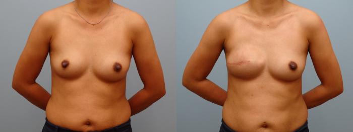 Before & After Breast Reconstruction Case 67 Front View in Anchorage, AK