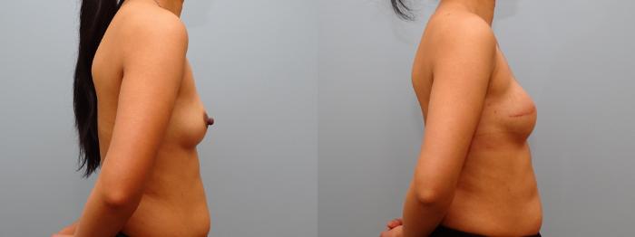 Before & After Breast Reconstruction Case 67 Right Side View in Anchorage, AK