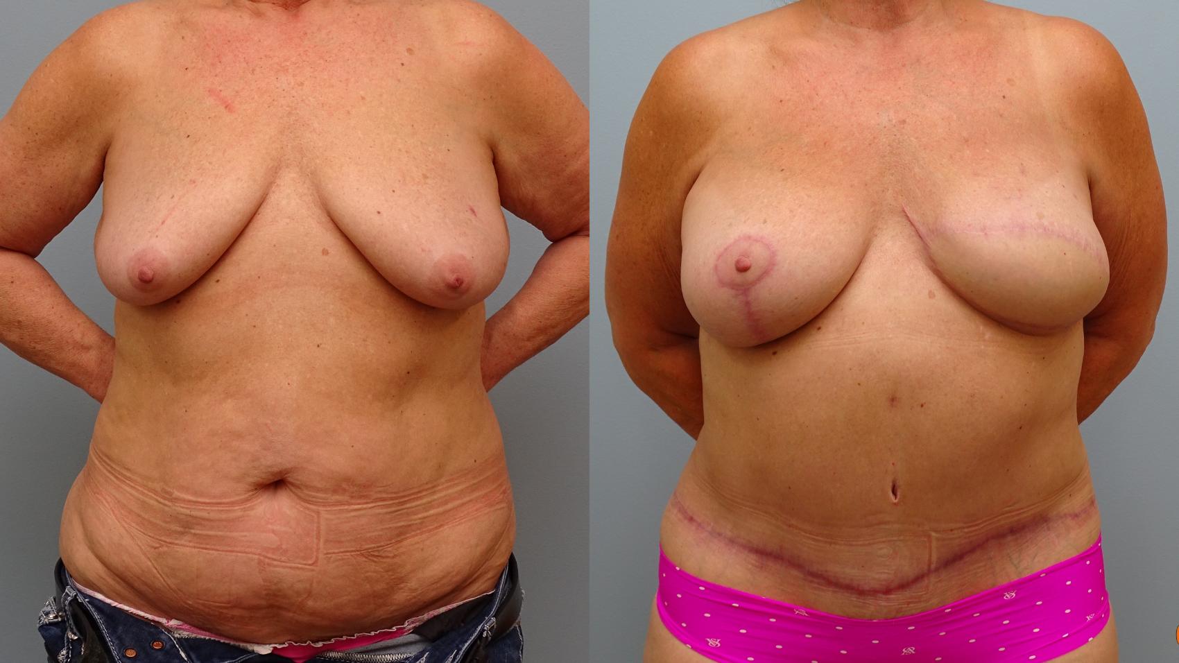 Before & After Breast Reconstruction Case 74 Front View in Anchorage, AK