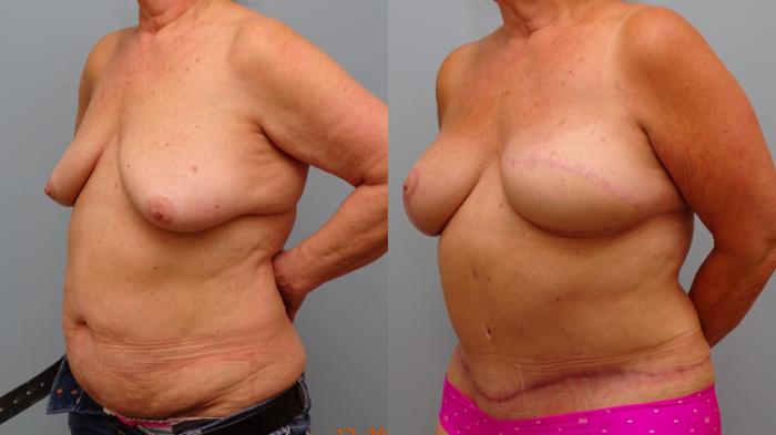 Before & After Breast Reconstruction Case 74 Left Oblique View in Anchorage, AK