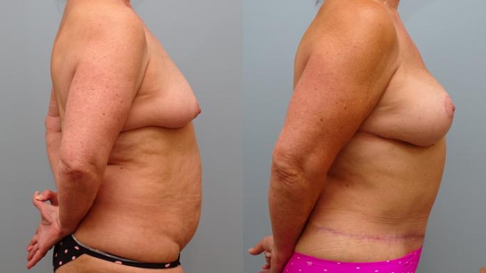 Before & After Breast Reconstruction Case 74 Right Side View in Anchorage, AK