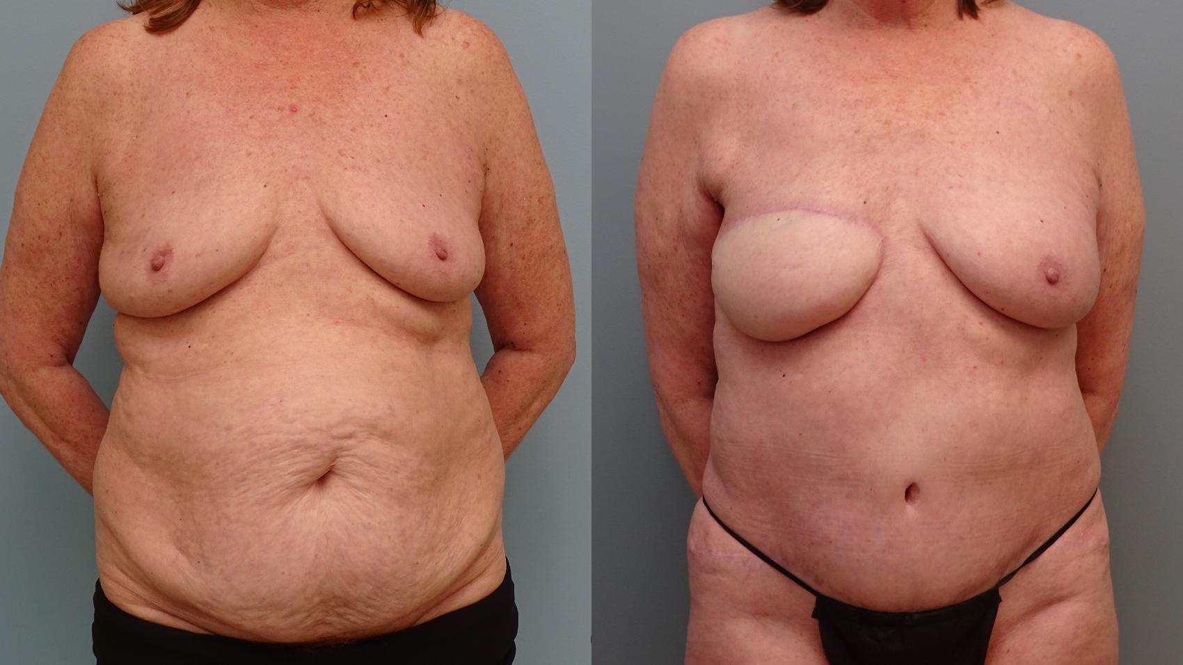 Before & After Breast Reconstruction Case 75 Front View in Anchorage, AK