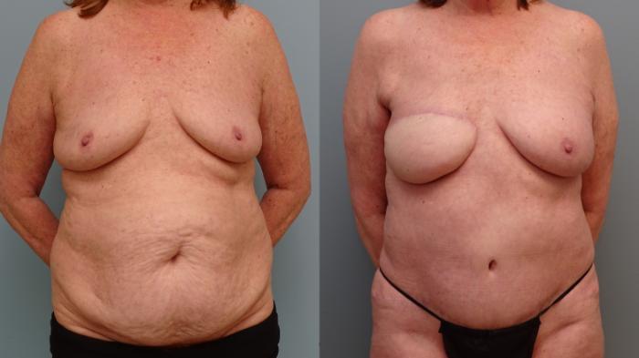 Before & After Breast Reconstruction Case 75 Front View in Anchorage, AK