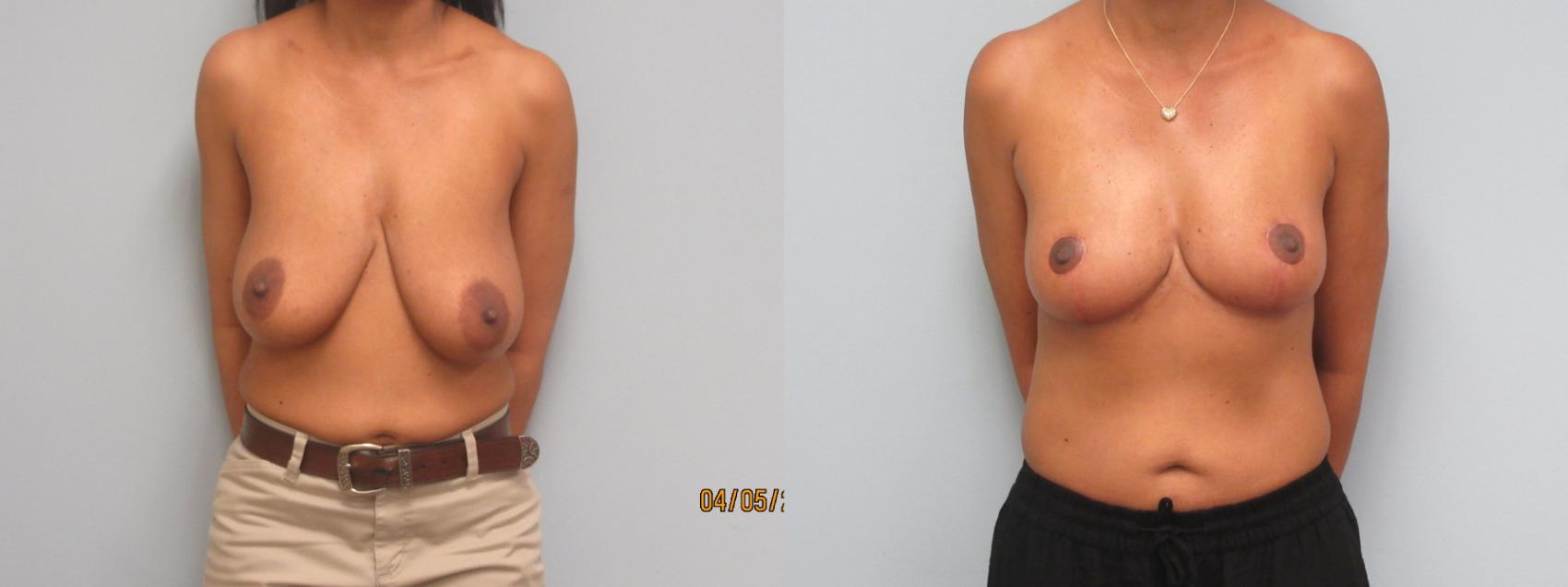 Before & After Breast Reduction Case 10 Front View in Anchorage, AK