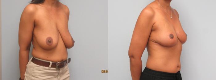 Before & After Breast Reduction Case 10 Right Oblique View in Anchorage, AK