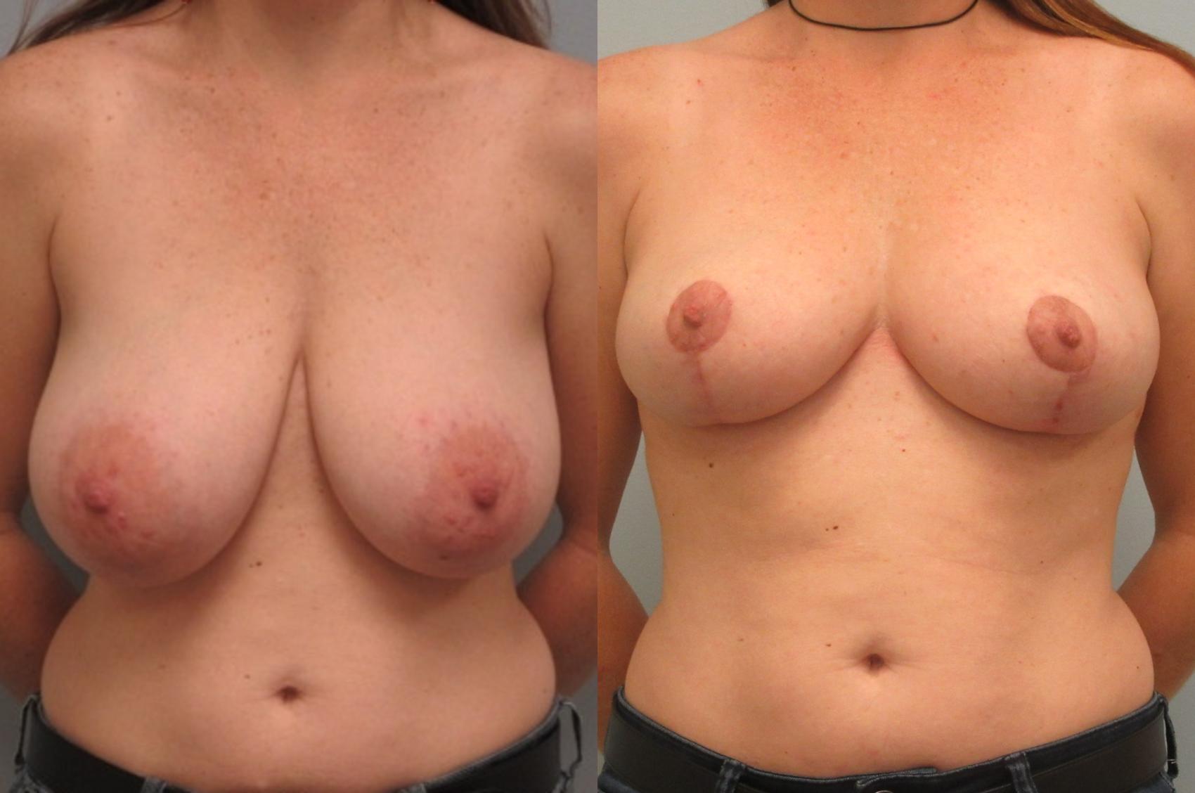 Before & After Breast Reduction Case 19 Front View in Anchorage, AK