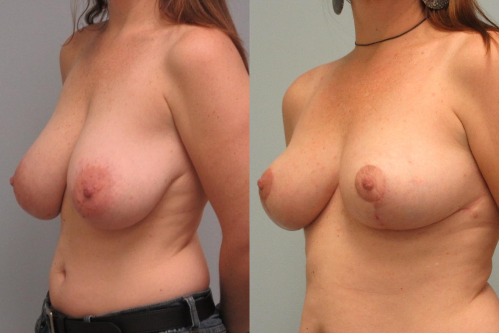 Before & After Breast Reduction Case 19 Left Oblique View in Anchorage, AK