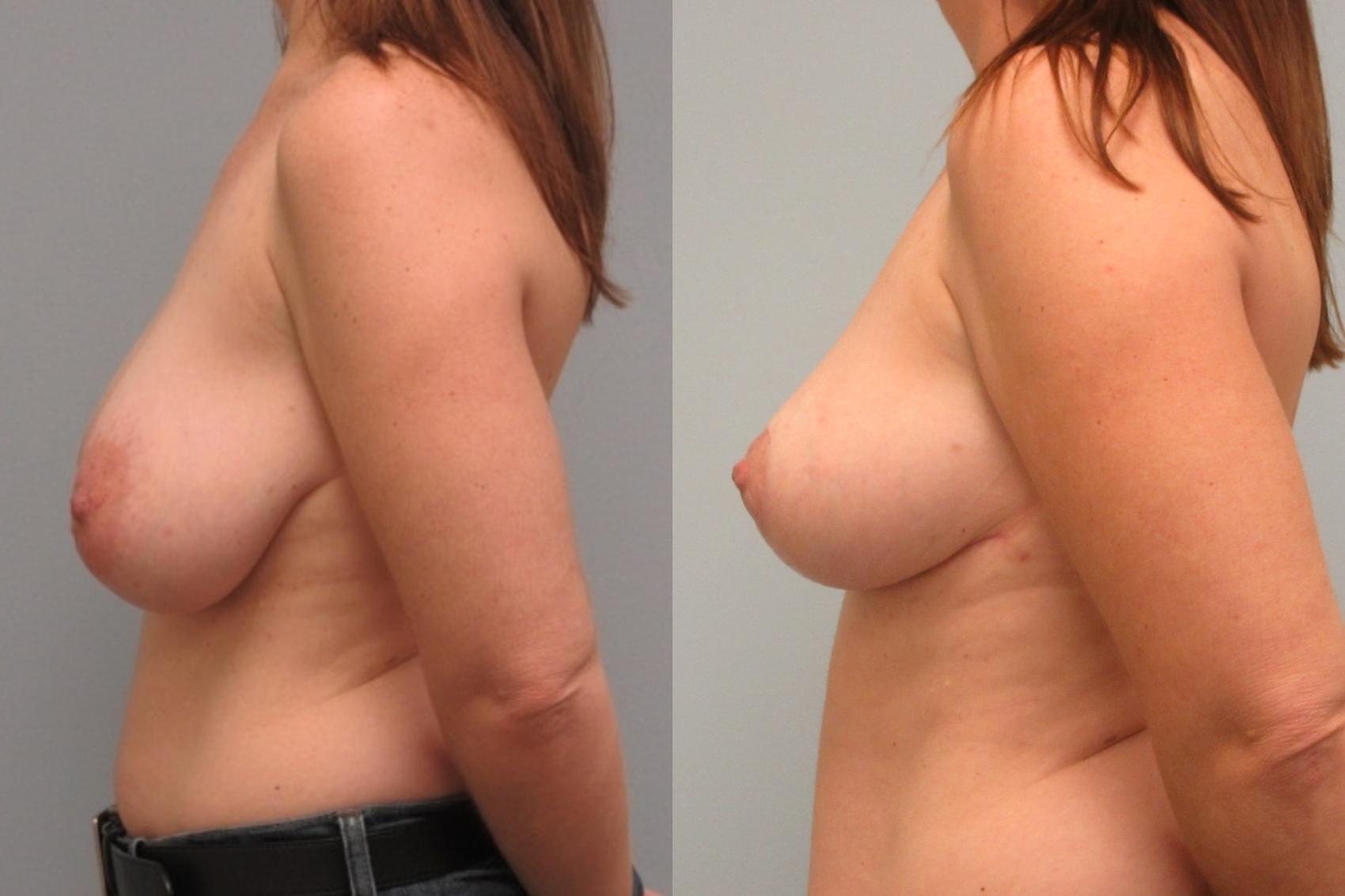 Before & After Breast Reduction Case 19 Left Side View in Anchorage, AK