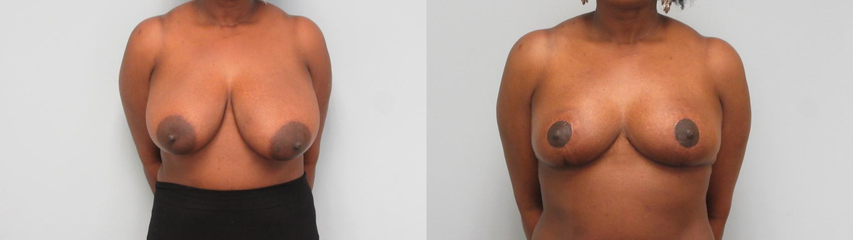 Before & After Breast Reduction Case 2 Front View in Anchorage, AK