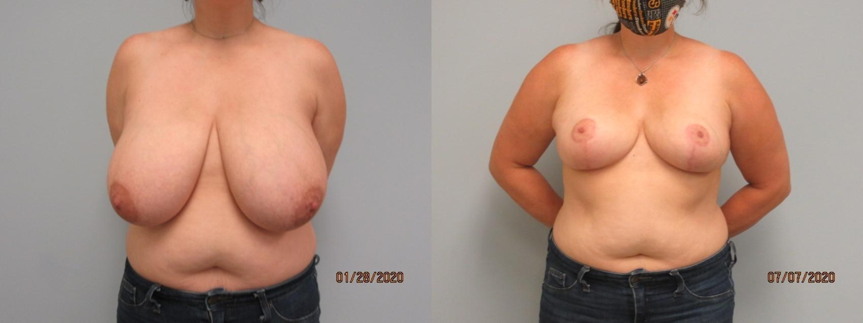 Before & After Breast Reduction Case 26 Front View in Anchorage, AK