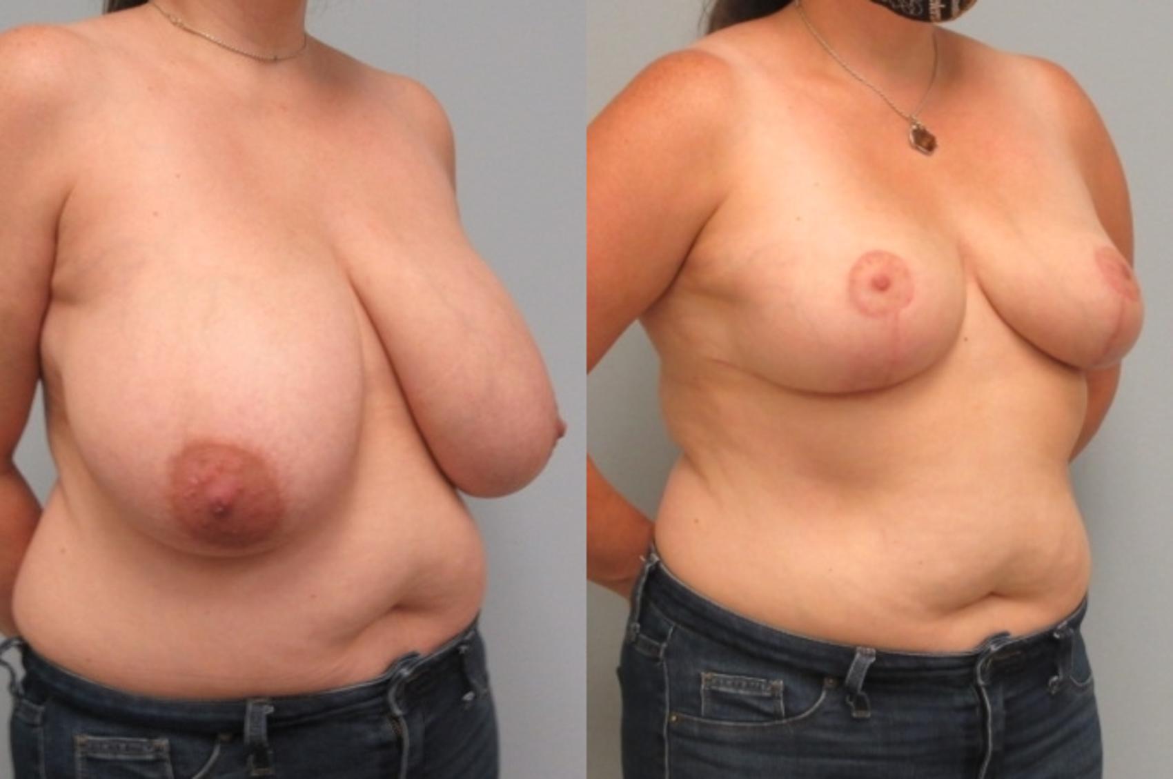 Before & After Breast Reduction Case 26 Right Oblique View in Anchorage, AK