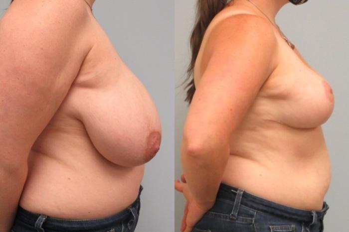 Before & After Breast Reduction Case 26 Right Side View in Anchorage, AK