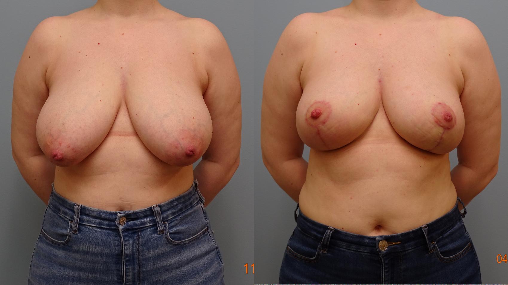 Before & After Breast Reduction Case 39 Front View in Anchorage, AK