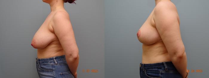 Before & After Breast Reduction Case 39 Left Side View in Anchorage, AK
