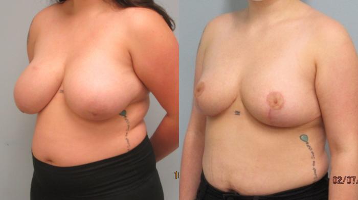 Before & After Breast Reduction Case 45 Left Oblique View in Anchorage, AK