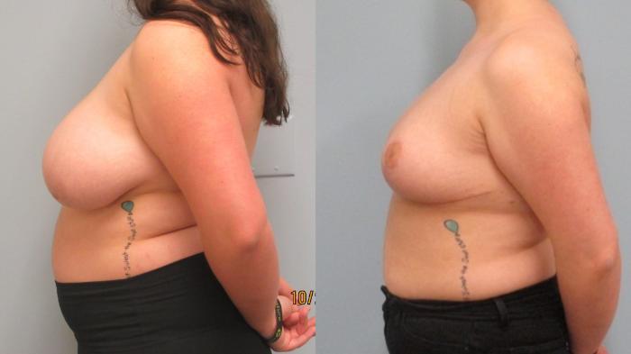 Before & After Breast Reduction Case 45 Left Side View in Anchorage, AK